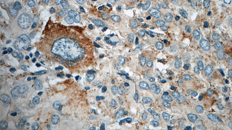 Immunohistochemistry of paraffin-embedded human gliomas tissue slide using Catalog No:114309(PTN Antibody) at dilution of 1:50 (under 40x lens)