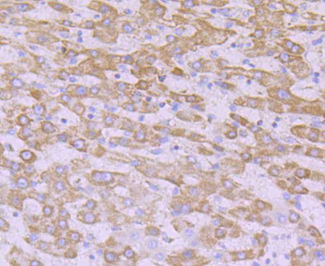 Fig3:; Immunohistochemical analysis of paraffin-embedded human liver carcinoma tissue using anti-NDUFB8 antibody. The section was pre-treated using heat mediated antigen retrieval with Tris-EDTA buffer (pH 8.0-8.4) for 20 minutes.The tissues were blocked in 5% BSA for 30 minutes at room temperature, washed with ddH; 2; O and PBS, and then probed with the primary antibody ( 1/50) for 30 minutes at room temperature. The detection was performed using an HRP conjugated compact polymer system. DAB was used as the chromogen. Tissues were counterstained with hematoxylin and mounted with DPX.