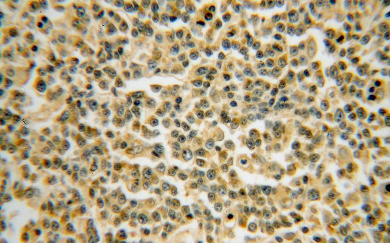Immunohistochemical of paraffin-embedded human lymphoma using Catalog No:108541(BTG1 antibody) at dilution of 1:50 (under 40x lens)