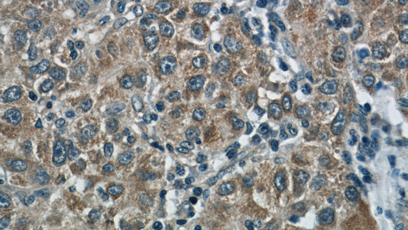 Immunohistochemistry of paraffin-embedded human liver cancer slide using Catalog No:111081(GLUL Antibody) at dilution of 1:50