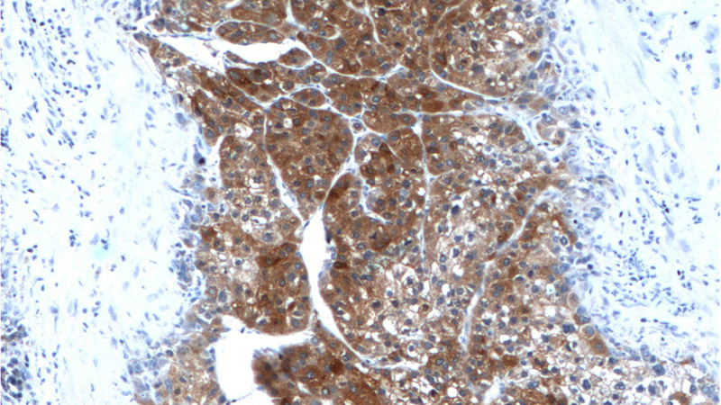 Immunohistochemistry of paraffin-embedded human liver cancer tissue slide using Catalog No:113725(PEX1 Antibody) at dilution of 1:200 (under 10x lens).