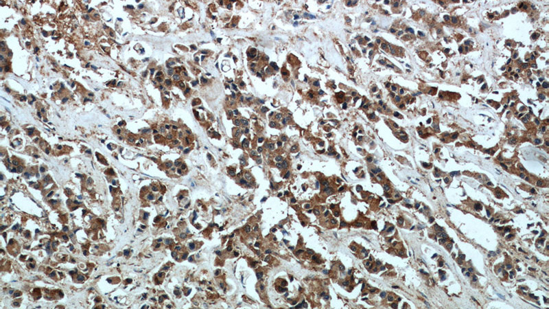 Immunohistochemical of paraffin-embedded human breast cancer using Catalog No:111247(GTSE1 antibody) at dilution of 1:50 (under 10x lens)