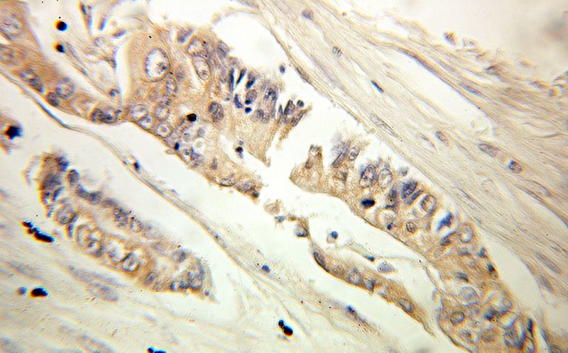 Immunohistochemical of paraffin-embedded human colon cancer using Catalog No:112776(MTHFD1 antibody) at dilution of 1:100 (under 10x lens)