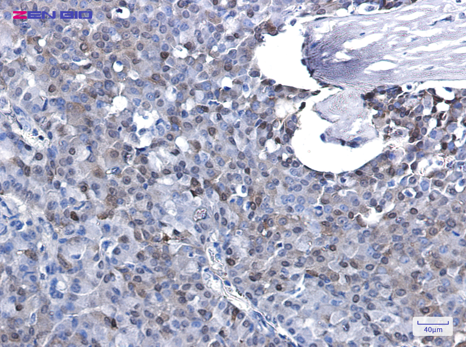 Immunohistochemistry of p27 KIP 1 in paraffin-embedded Human breast cancer tissue using p27 KIP 1 Rabbit pAb at dilution 1/20