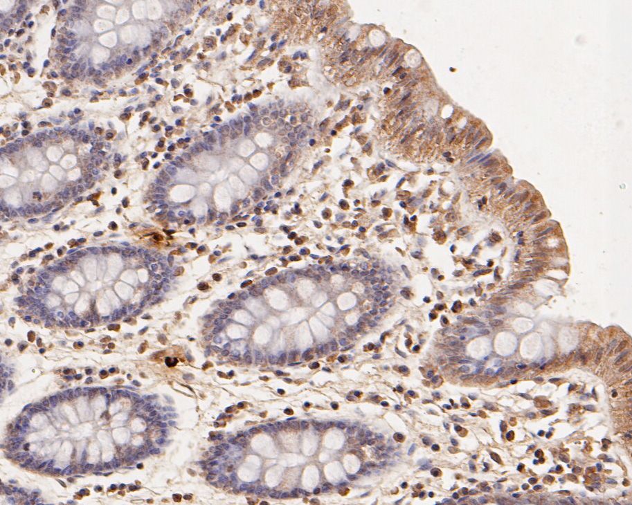 Fig2:; Immunohistochemical analysis of paraffin-embedded human colon tissue using anti-CCL2/MCP1 antibody. The section was pre-treated using heat mediated antigen retrieval with Tris-EDTA buffer (pH 8.0-8.4) for 20 minutes.The tissues were blocked in 5% BSA for 30 minutes at room temperature, washed with ddH; 2; O and PBS, and then probed with the primary antibody ( 1/800) for 30 minutes at room temperature. The detection was performed using an HRP conjugated compact polymer system. DAB was used as the chromogen. Tissues were counterstained with hematoxylin and mounted with DPX.