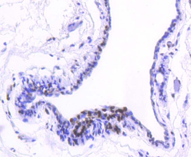 Fig7: Immunohistochemical analysis of paraffin-embedded human breast carcinoma tissue using anti-Histone H2B(acetyl K20) antibody. Counter stained with hematoxylin.