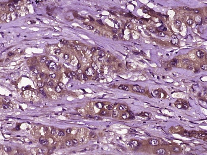 Fig2: Paraformaldehyde-fixed, paraffin embedded (human liver carcinoma); Antigen retrieval by boiling in sodium citrate buffer (pH6.0) for 15min; Block endogenous peroxidase by 3% hydrogen peroxide for 20 minutes; Blocking buffer (normal goat serum) at 37℃ for 30min; Antibody incubation with (SGLT1) Polyclonal Antibody, Unconjugated at 1:400 overnight at 4℃, followed by operating according to SP Kit (Rabbit) (sp-0023) instructionsand DAB staining.