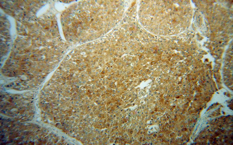 Immunohistochemical of paraffin-embedded human liver cancer using Catalog No:114095(PPP2CA antibody) at dilution of 1:50 (under 10x lens)