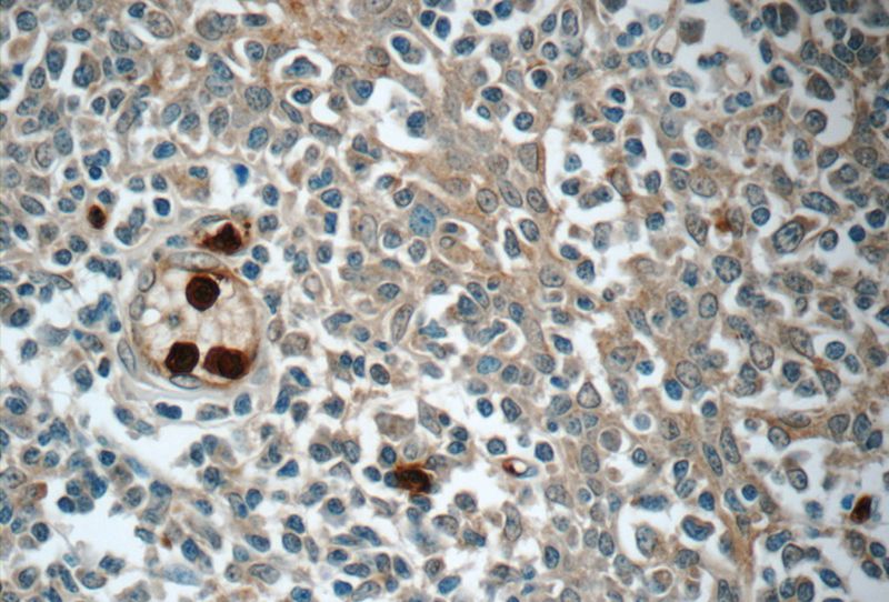 Immunohistochemistry of paraffin-embedded human tonsillitis tissue slide using Catalog No:112400(LY6G5B Antibody) at dilution of 1:50 (under 40x lens)