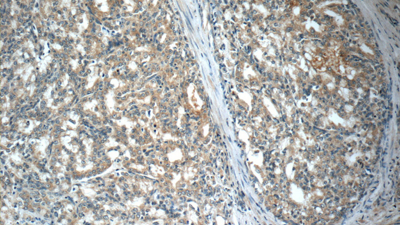 Immunohistochemistry of paraffin-embedded human prostate cancer slide using Catalog No:112704(MMP26 Antibody) at dilution of 1:50