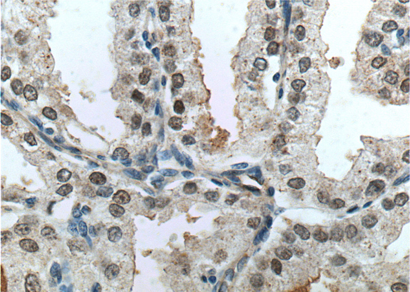 Immunohistochemistry of paraffin-embedded human prostate cancer tissue slide using Catalog No:110745(FOXA1 Antibody) at dilution of 1:200 (under 40x lens). heat mediated antigen retrieved with Tris-EDTA buffer(pH9).