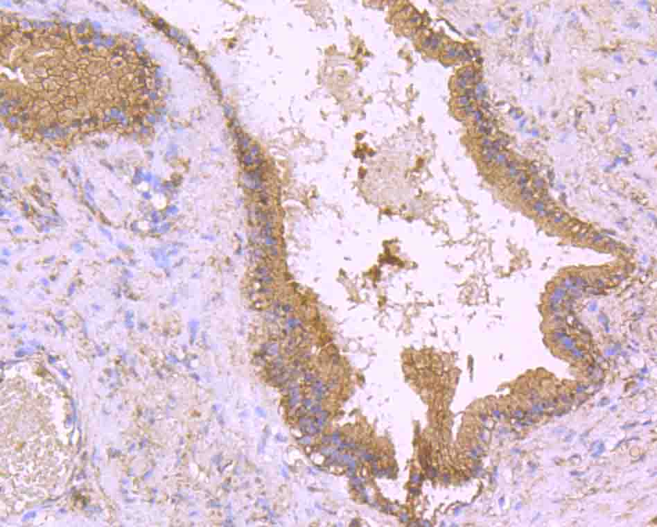 Fig6: Immunohistochemical analysis of paraffin-embedded human prostate tissue using anti-CD130 antibody. Counter stained with hematoxylin.