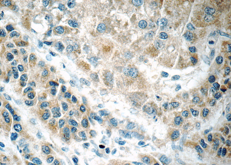 Immunohistochemistry of paraffin-embedded human liver cancer tissue slide using Catalog No:110720(FREM1 Antibody) at dilution of 1:50 (under 40x lens)