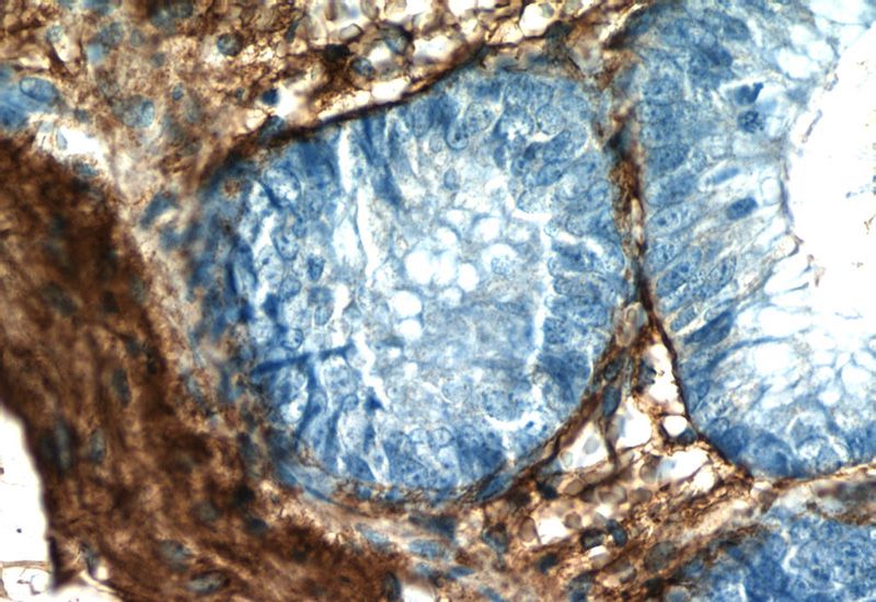 Immunohistochemistry of paraffin-embedded human colon slide using Catalog No:109377(COL3A1 Antibody) at dilution of 1:50 (under 40x lens)