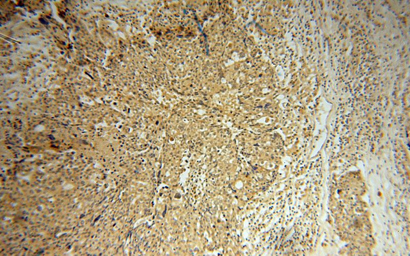 Immunohistochemical of paraffin-embedded human ovary tumor using Catalog No:113683(PCBD1 antibody) at dilution of 1:50 (under 10x lens)