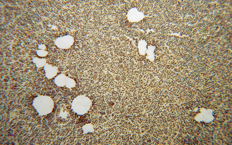 Immunohistochemical of paraffin-embedded human lymphoma using Catalog No:112287(PSMB8 antibody) at dilution of 1:50 (under 10x lens)