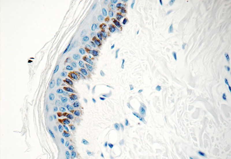 Immunohistochemistry of paraffin-embedded human skin tissue slide using Catalog No:111904(KLK5 Antibody) at dilution of 1:50 (under 40x lens)