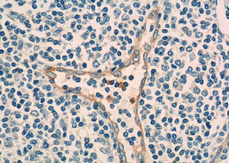 Immunohistochemistry of paraffin-embedded human tonsillitis tissue slide using Catalog No:109148(CD93 Antibody) at dilution of 1:50 (under 40x lens)