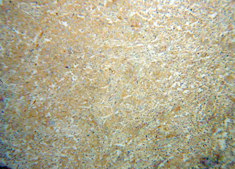 Immunohistochemical of paraffin-embedded human breast cancer using Catalog No:108240(ARD1A antibody) at dilution of 1:100 (under 10x lens)