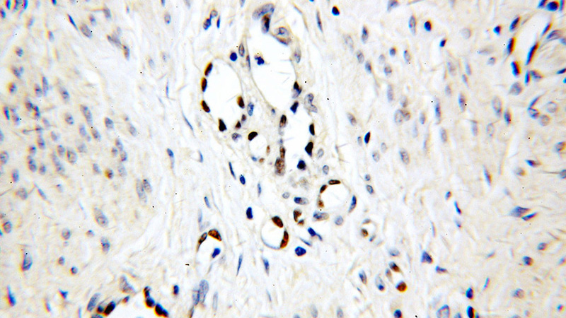 Immunohistochemical of paraffin-embedded human cervical cancer using Catalog No:113967(PLK1 antibody) at dilution of 1:50 (under 40x lens)