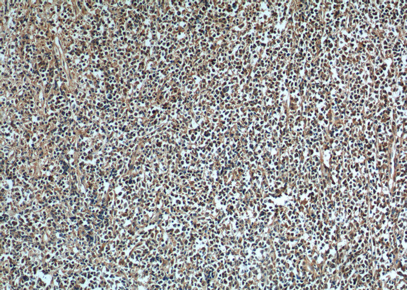 Immunohistochemistry of paraffin-embedded human lymphoma tissue slide using Catalog No:107073(AURKB Antibody) at dilution of 1:200 (under 10x lens). heat mediated antigen retrieved with Tris-EDTA buffer(pH9).