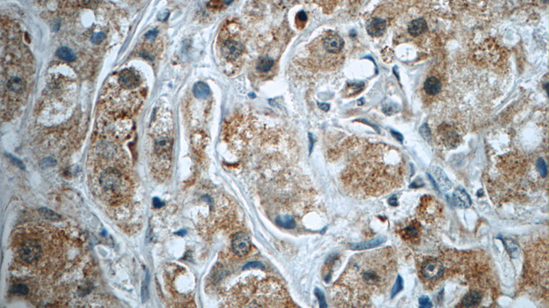 Immunohistochemistry of paraffin-embedded human breast cancer tissue slide using Catalog No:115658(SQLE Antibody) at dilution of 1:50 (under 40x lens)