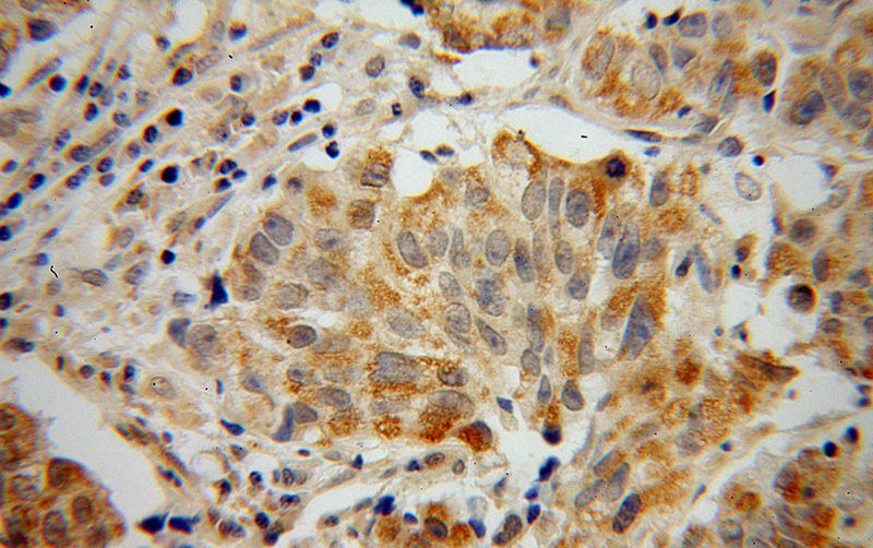 Immunohistochemical of paraffin-embedded human prostate cancer using Catalog No:115536(SPAG8 antibody) at dilution of 1:100 (under 40x lens)