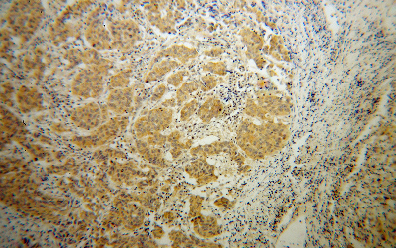 Immunohistochemical of paraffin-embedded human prostate cancer using Catalog No:116146(TNK1 antibody) at dilution of 1:100 (under 10x lens)
