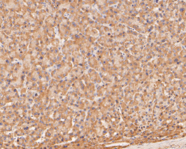 Fig3:; Immunohistochemical analysis of paraffin-embedded human liver carcinoma tissue using anti-TREM2 antibody. The section was pre-treated using heat mediated antigen retrieval with Tris-EDTA buffer (pH 8.0-8.4) for 20 minutes.The tissues were blocked in 5% BSA for 30 minutes at room temperature, washed with ddH; 2; O and PBS, and then probed with the primary antibody ( 1/50) for 30 minutes at room temperature. The detection was performed using an HRP conjugated compact polymer system. DAB was used as the chromogen. Tissues were counterstained with hematoxylin and mounted with DPX.