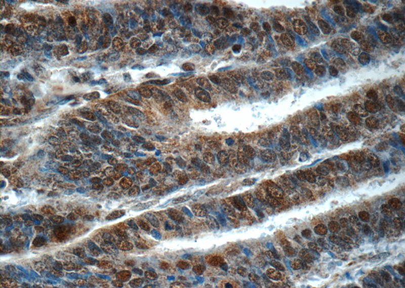 Immunohistochemistry of paraffin-embedded human endometrial cancer tissue slide using Catalog No:114839(RPS27A Antibody) at dilution of 1:50 (under 40x lens)