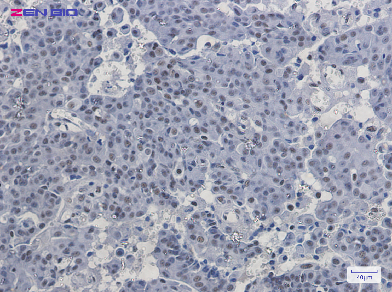 Immunohistochemistry of PABPN1 in paraffin-embedded Human breast cancer tissue using PABPN1 Rabbit pAb at dilution 1/20