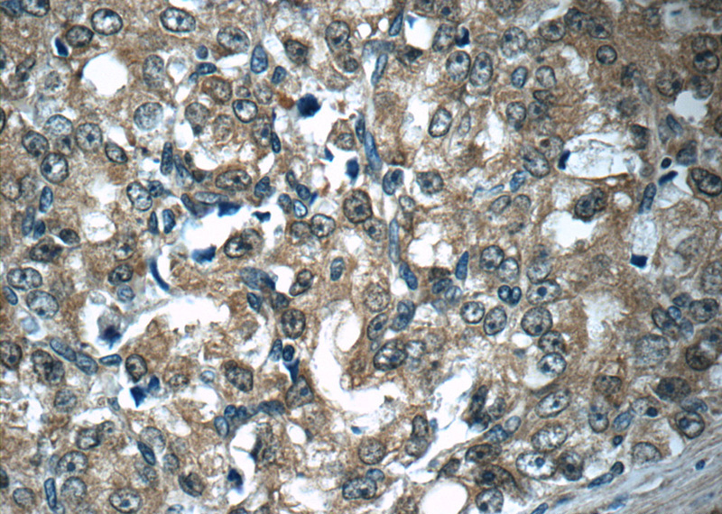 Immunohistochemistry of paraffin-embedded human prostate cancer tissue slide using Catalog No:107995(ACY1 Antibody) at dilution of 1:50 (under 40x lens)