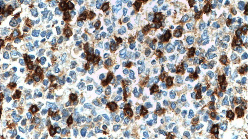 Immunohistochemistry of paraffin-embedded human tonsillitis tissue slide using Catalog No:109135(CD69 Antibody) at dilution of 1:200 (under 40x lens). heat mediated antigen retrieved with Tris-EDTA buffer(pH9).