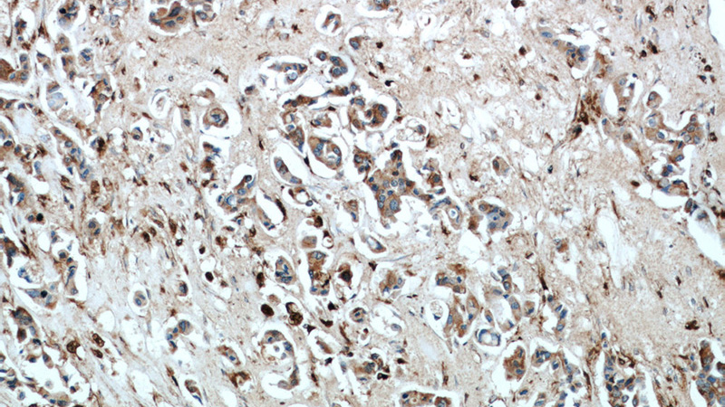 Immunohistochemical of paraffin-embedded human breast cancer using Catalog No:108888(CTSD antibody) at dilution of 1:50 (under 10x lens)
