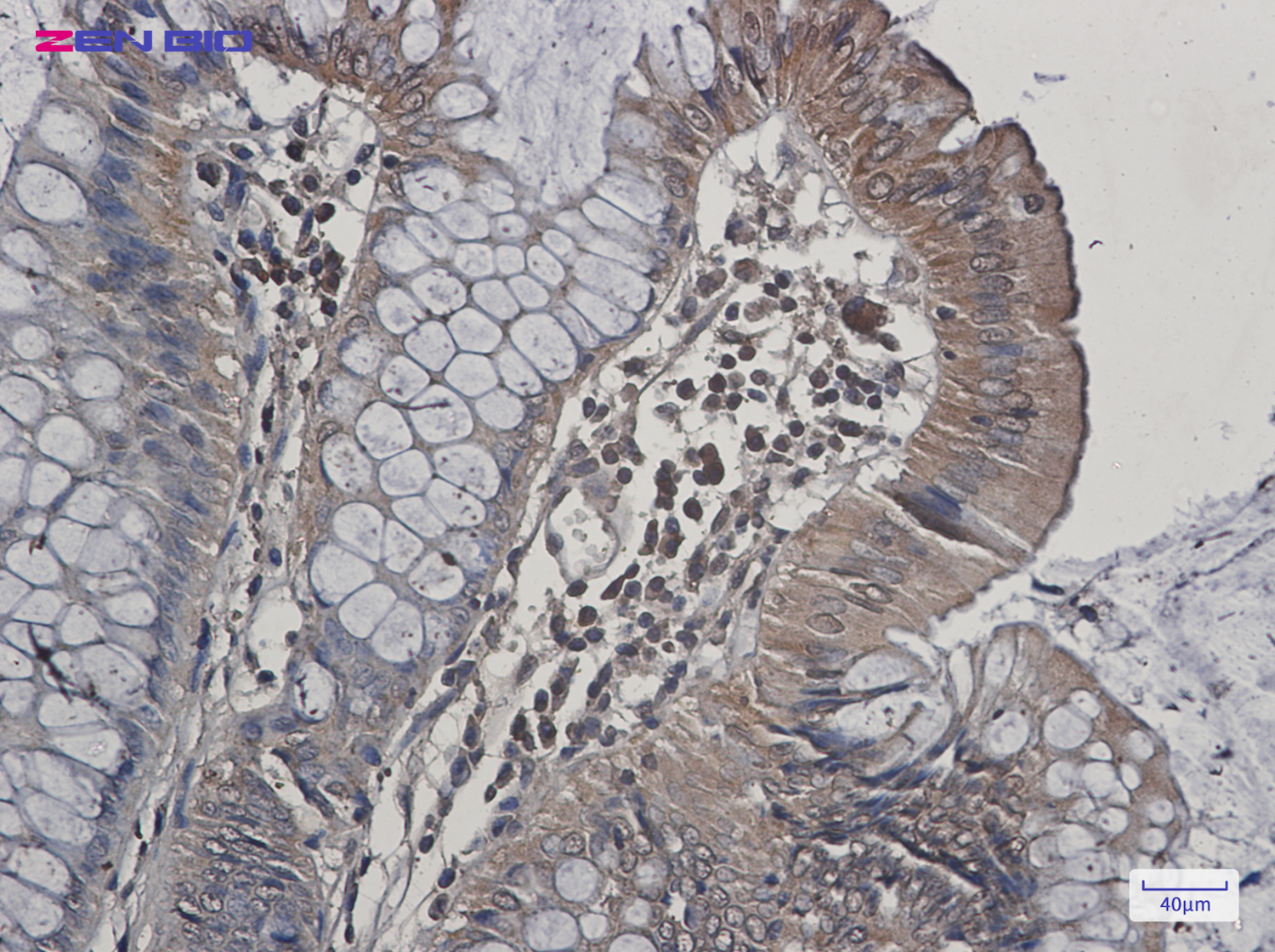 Immunohistochemistry of JNK2 in paraffin-embedded Human colon cancer tissue using JNK2 Rabbit pAb at dilution 1/20