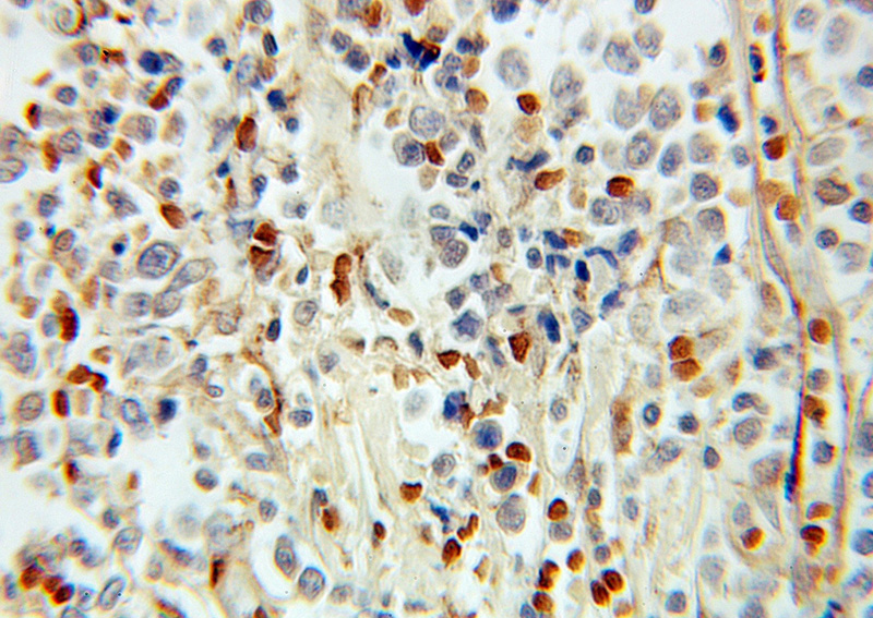 Immunohistochemical of paraffin-embedded human lymphoma using Catalog No:113806(PHF11 antibody) at dilution of 1:100 (under 10x lens)