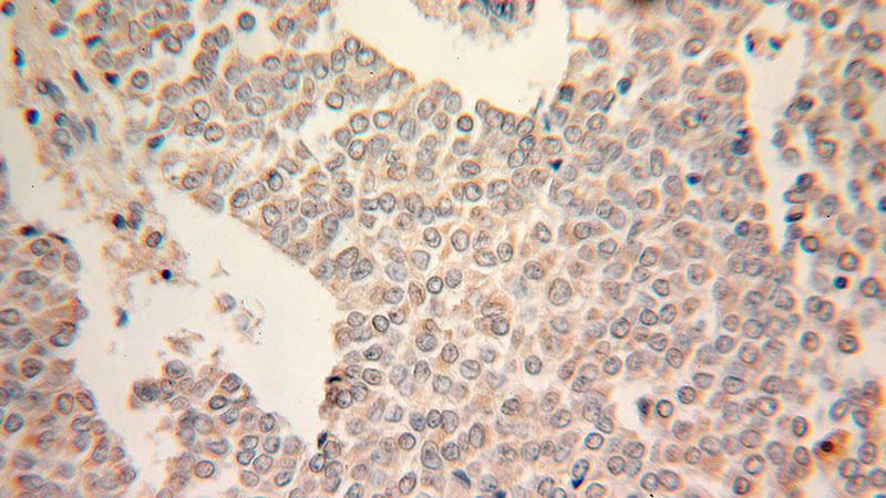 Immunohistochemical of paraffin-embedded human ovary tumor using Catalog No:116557(UGP2 antibody) at dilution of 1:100 (under 25x lens)