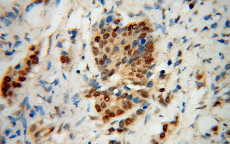 Immunohistochemical of paraffin-embedded human gliomas using Catalog No:113986(PNRC2 antibody) at dilution of 1:50 (under 40x lens)
