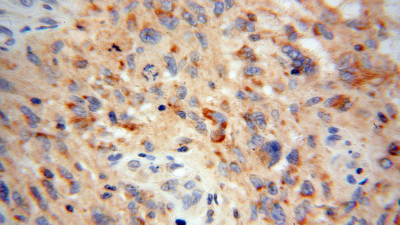Immunohistochemical of paraffin-embedded human gliomas using Catalog No:115930(TDRKH antibody) at dilution of 1:100 (under 40x lens)