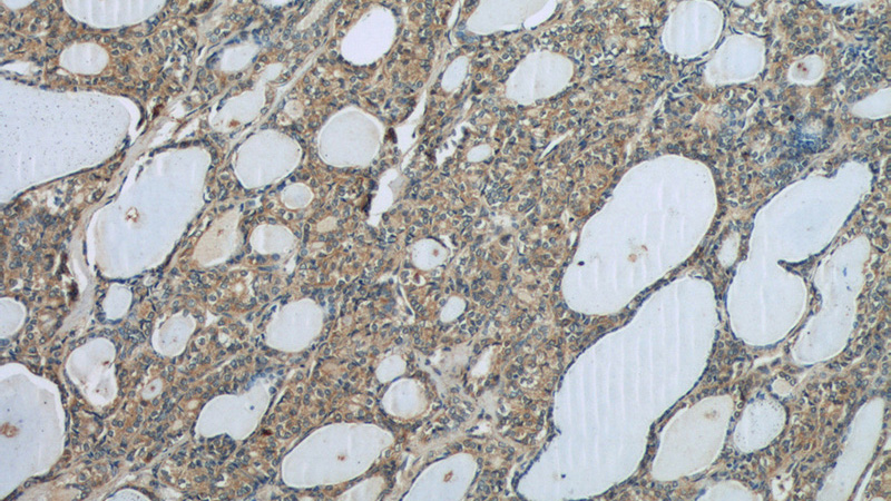 Immunohistochemistry of paraffin-embedded human thyroid cancer tissue slide using Catalog No:117222(BRAF Antibody) at dilution of 1:50 (under 10x lens)