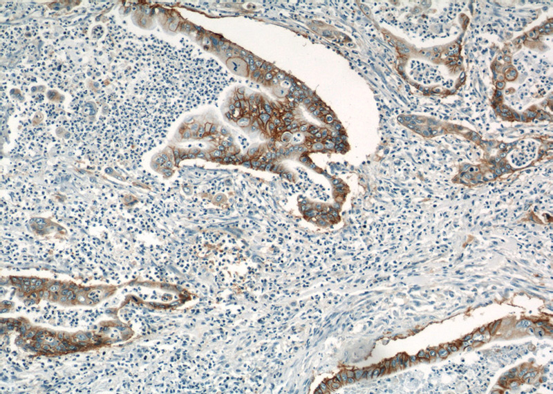 Immunohistochemical of paraffin-embedded human pancreas cancer using Catalog No:111864(ITGB4 antibody) at dilution of 1:100 (under 10x lens)