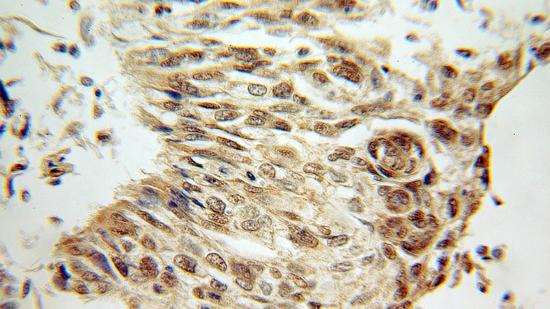 Immunohistochemical of paraffin-embedded human lung cancer using Catalog No:112349(LSM4 antibody) at dilution of 1:100 (under 10x lens)