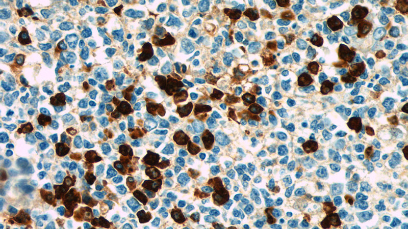 Immunohistochemistry of paraffin-embedded human tonsillitis tissue slide using Catalog No:111695(IGHD Antibody) at dilution of 1:50 (under 40x lens)