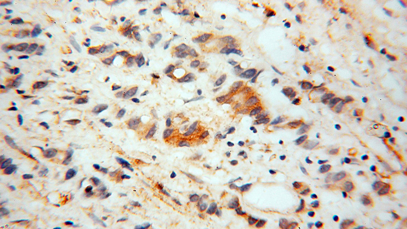 Immunohistochemical of paraffin-embedded human gliomas using Catalog No:113291(NOG antibody) at dilution of 1:50 (under 40x lens)