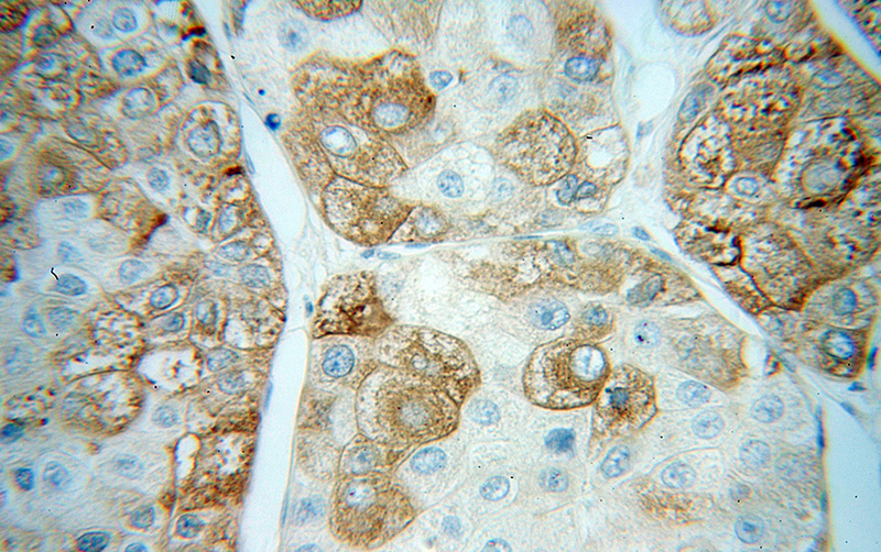 Immunohistochemical of paraffin-embedded human liver cancer using Catalog No:109533(CPVL antibody) at dilution of 1:200 (under 40x lens)