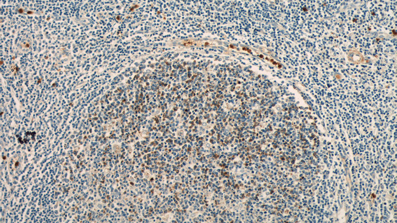 Immunohistochemistry of paraffin-embedded human tonsillitis tissue slide using Catalog No:116073(TLR3 Antibody) at dilution of 1:50 (under 10x lens)