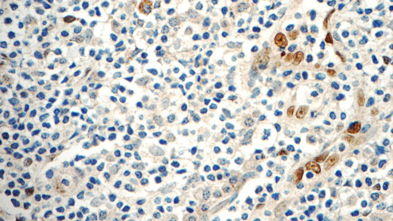 Immunohistochemistry of paraffin-embedded human tonsillitis tissue slide using Catalog No:111738(IL33 Antibody) at dilution of 1:50 (under 40x lens)