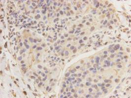 Fig3: Immunohistochemical analysis of paraffin- embedded human breast carcinoma tissue using anti-KIAA0100 Mouse mAb (Cat. # 176654#).