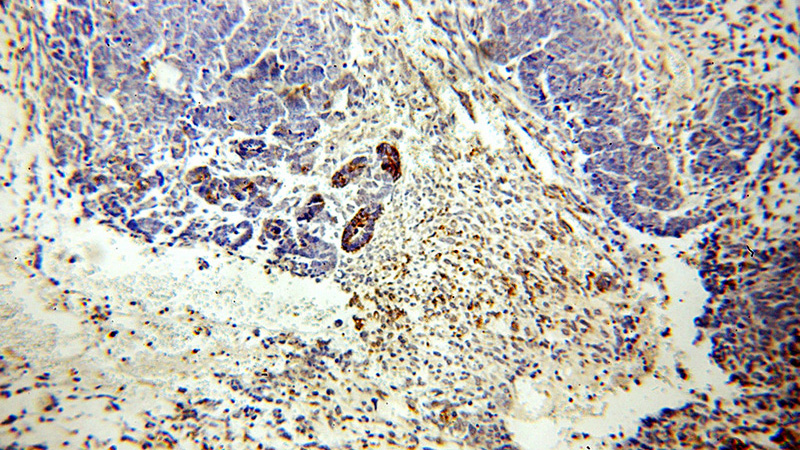 Immunohistochemical of paraffin-embedded human ovary tumor using Catalog No:112685(MLN64,STARD3 antibody) at dilution of 1:200 (under 10x lens)
