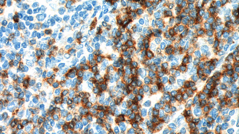 Immunohistochemistry of paraffin-embedded human tonsillitis tissue slide using Catalog No:109136(CD7 Antibody) at dilution of 1:200 (under 40x lens). heat mediated antigen retrieved with Tris-EDTA buffer(pH9).